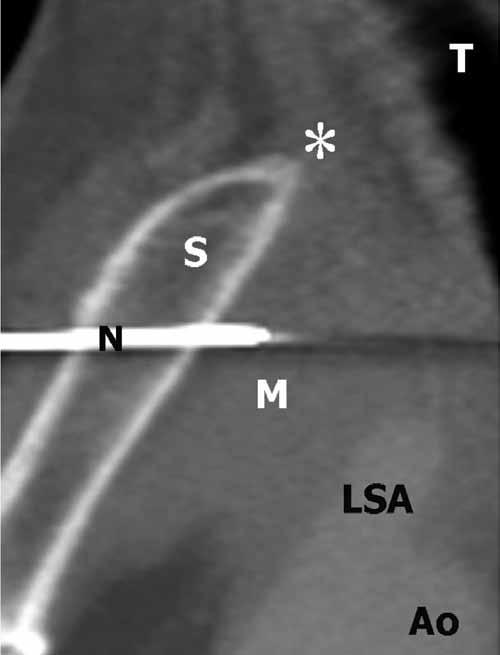 nter of mass is far from the sternal notch (asterisk), which makes the supra-sternal biopsy impossible. c.