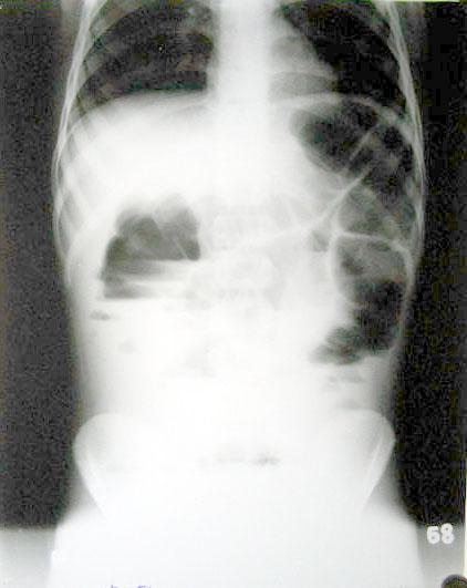Total major operations: 1218, Total minor operations: 1527 Intestinal obstruction in infants and children =100 Cases Investigations: All patients had a plain x-ray of