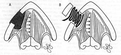 Gortex) Posterior larynx modification Arytenoid