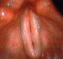 Thyroplasty Type I Implants Thyroplasty (contin d)