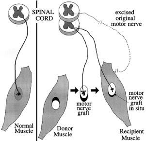 Nerve Muscle Pedicle Reinnervation Attach a nearby nerve to TA muscle Attach a pedicle of a strap muscle with innervation to PCA or adductors Reduces muscle atrophy Usually combined with