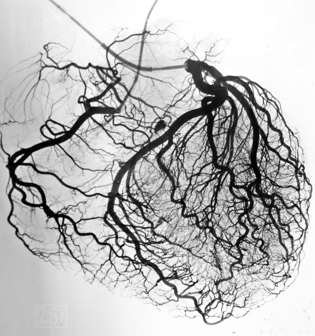 3D stereo-arteriography resolves: Collateral connections