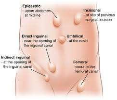 Hernia Causing SB0 Definition hernia Abnormal protrusion of viscus thro normal or abnormal defects of body cavity Hernia- obstruction Untreated strangulation