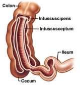 Telescoping of intestine into one another 2 types : idiopathic enteroenteral intussusception (jejunojejunal, jejunoileal, ileoileal), Associated with special medical