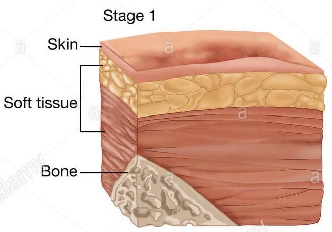 Pressure ulcers are staged I IV Eschared ulcers are called unstageable Deep tissue injury is a precursor to