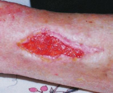 Wound not healing? You may need to rethink the plan of care. Granulation tissue A granulating wound should be protected from reinjury. Hydrocolloids or hydrogels may be a good choice.