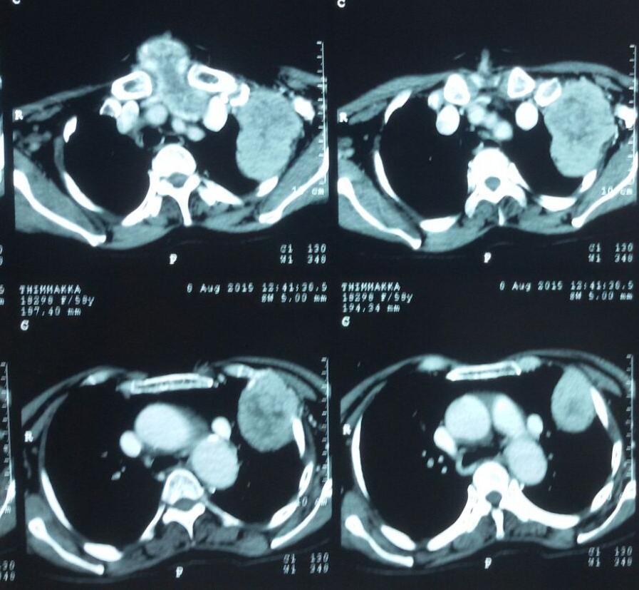 Figure 7: CT scan picture showing
