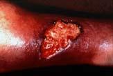 VENOUS INSUFFICIENCY ULCERS VENOUS INSUFFICIENCY ULCERS Affects 1% of the general population Affects 3.