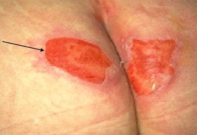 Presence of blanchable erythema or changes to sensation