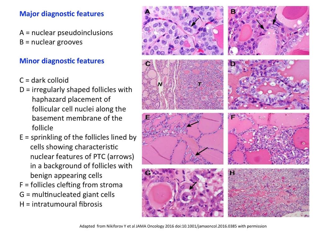 Figure 1: Major and minor diagnostic features of NIFTP Exclusion criteria: - any capsular or vascular invasion; but if the whole capsule has not been examined thoroughly then the default diagnosis is