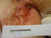 Contact Dermatitis and Radiation Ulcers 88 YO female SCC breast 1997 with excision, graft and radiation
