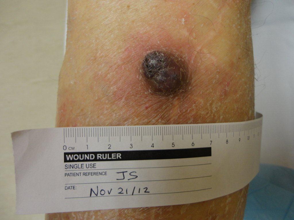 This can occur after radiation, or in chronic lymphedema 78YO male Referred from orthopedics with seven week hx