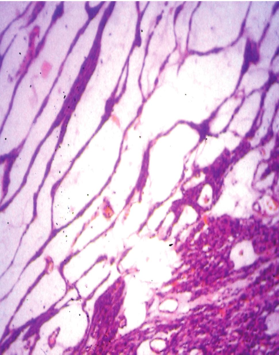 Kanapilly Francis Magdalene et al. The gross specimen received in the histopathology lab showed an enlarged thyroid that weighed 80g. One lobe was enlarged and measured 6 4 cm.