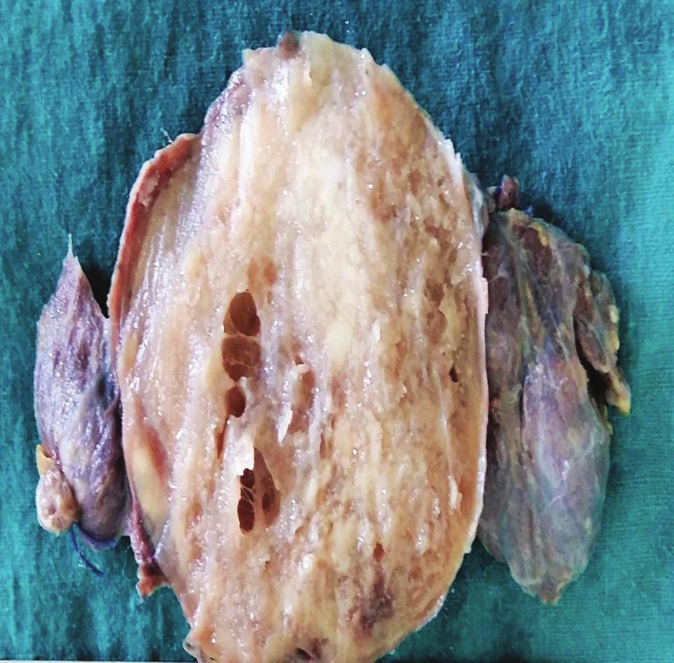 There was an enlarged nodule that measured 8 8 cm identified in the isthmus, the cut surface of which revealed a well circumscribed encapsulated lesion with cystic and spongy areas (Figure 1).