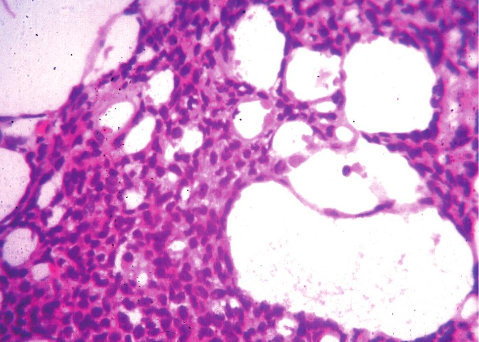 Cribriform-Morular Variant of Papillary Carcinoma multifocal. The C-MV exhibits a combination of cribriform, follicular, trabecular, solid, and papillary patterns of growth with morular areas.
