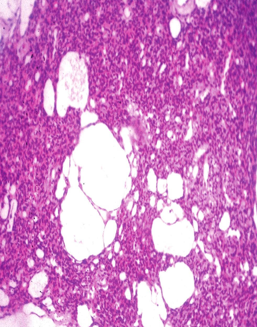 Since these tumors were morphologically indistinguishable from thyroid carcinomas that arise in the FAP, currently the term C-MV has been approved to describe tumors that occur in both