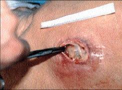 Infected Pressure Ulcer Marked by and increased wound size, perilesional warmth and