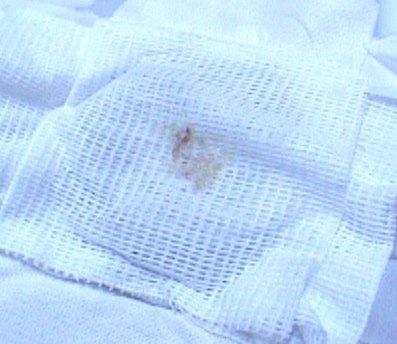 Wound Treatments: Gauze Purpose to absorb; supports moist wound healing if kept moist; used to fill sinuses or