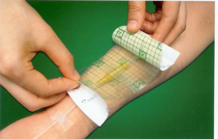 Wound Treatments: Transparent Film The first occlusive dressings; insulate; protect; and maintain the