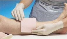Wound Treatments: Foams Foams: Non-adherent wafers;