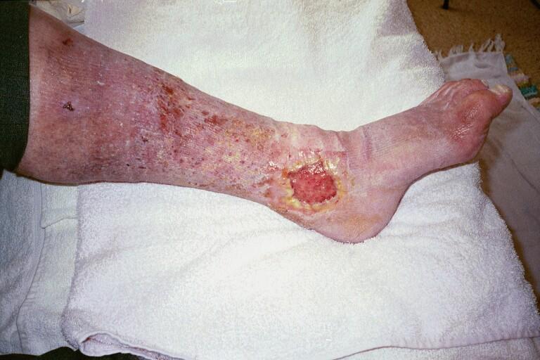 J. (1998). Contact sensitivity in eczema in leg ulcer patients. In N. Cullum & N. Roe.