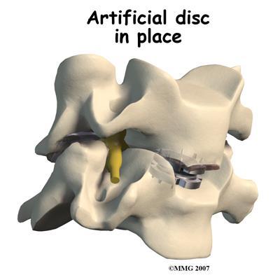 enlarging the disc space, the nearby spinal ligaments are pulled tight, which helps hold the prosthesis in place. The prosthesis is further held in place by the normal pressure through the spine.