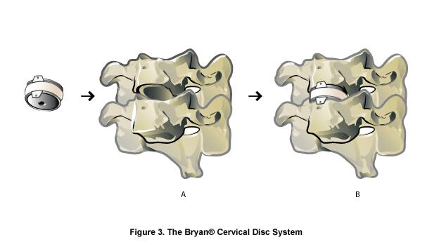 Bryan Cervical Disc System: The Bryan Cervical Disc System (Medtronic Inc.