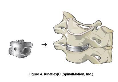 KineflexlC Spinal System: The KineflexlC Spinal System (SpinalMotion Inc.) consists of two end plates and a mobile center core within a retention ring.