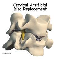 Introduction Artificial disc replacement (ADR) is relatively new. In June 2004, the first ADR for the lumbar spine (low back) was approved by the FDA for use in the US.