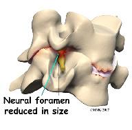 The traditional way of treating severe neck pain caused by disc degeneration is a procedure called an anterior cervical discectomy and fusion.