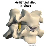 removed. The surgeon will also remove any disc fragments pressing against the nerve and shave off any osteophytes (bone spurs). The disc space is distracted (jacked up) to its normal disc height.