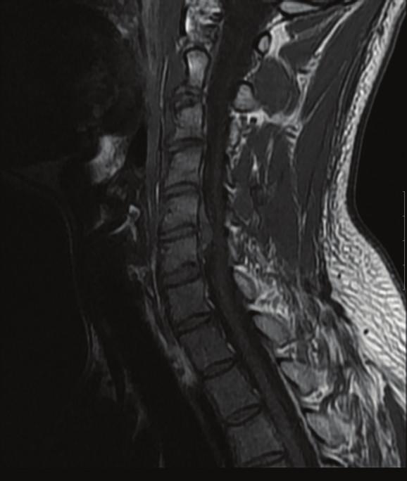 diagnosed using computed tomography and approximately 47casesonlywerediagnosedusingMRI[1, 3 6].