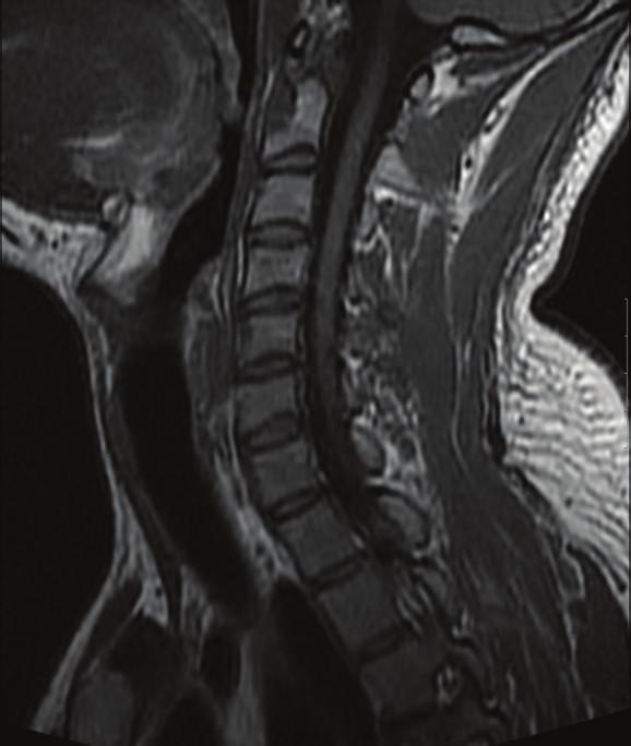 Conclusion Spontaneous regression of large herniated cervical discs is a welcome phenomenon which probably all suffering patients will dream to experience.