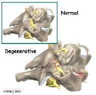 Intervertebral disc An intervertebral disc fits between the vertebral bodies and provides a space between the spine bones. The disc normally works like a shock absorber.