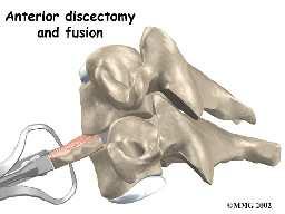 Fusion A fusion surgery joins two or more bones into one solid bone.
