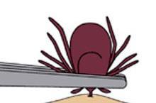 How to Remove a Tick: Use tweezers to grasp the tick as close to the skin's as possible. Pull upward with steady, even pressure.