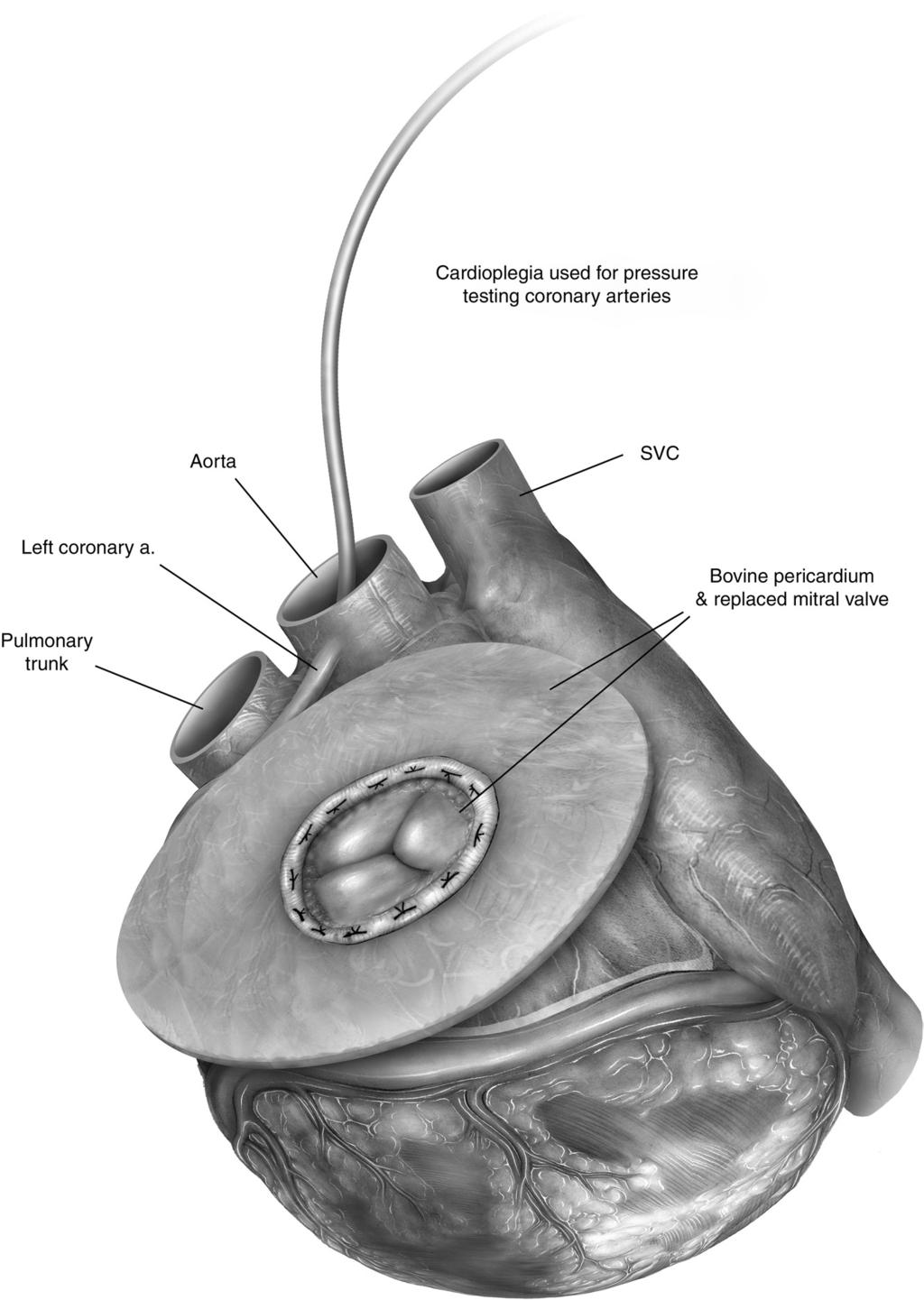 Cardiac autotransplantation 157 Figure 11 After reconstruction of the anterior left atrium, we use a handheld cannula to directly inject cold blood K cardioplegia into the left
