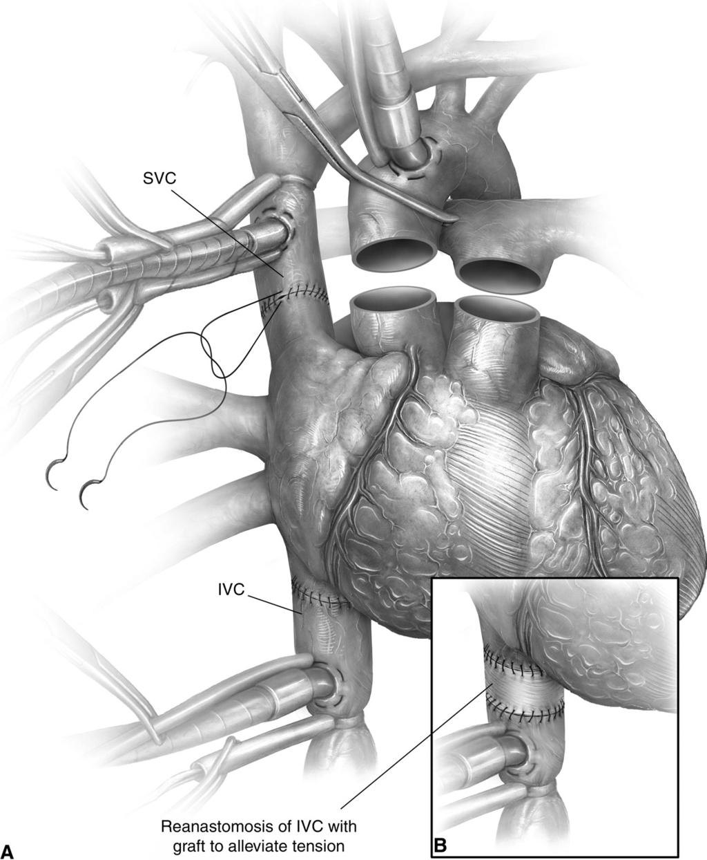 Cardiac autotransplantation 159 Figure 13 (A) We next suture the inferior vena cava right atrial junction and then the superior vena cava right atrial junction with 5-0 Prolene sutures.