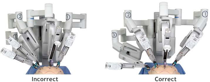 18 Robotic Surgery Fig. 23: Depiction of the correct method of docking of patient cart Fig.
