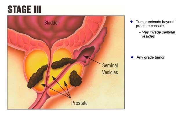 Prostate Cancer T3 Has spread beyond the prostate T3a