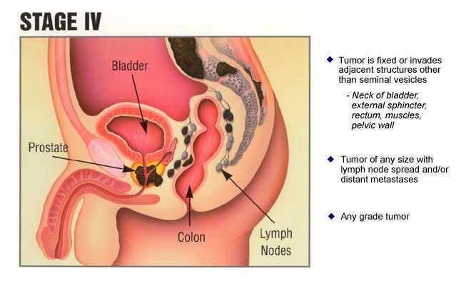 Prostate Cancer T4 Cancer has invaded local organs Bladder invasion