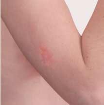 3 skin irritation Irritants are chemicals that cause skin damage that is reversible (unlike corrosion, which is irreversible).
