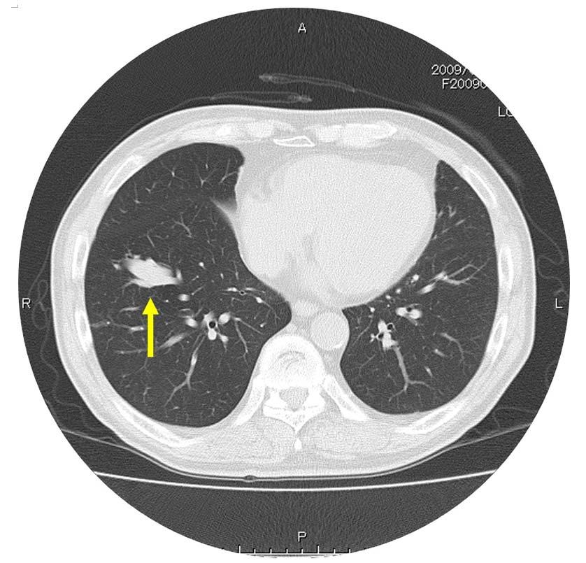 2 Case report An 81-year-old man was referred to our hospital because of bloody sputum. Chest radiography showed a tumor in the right lung.