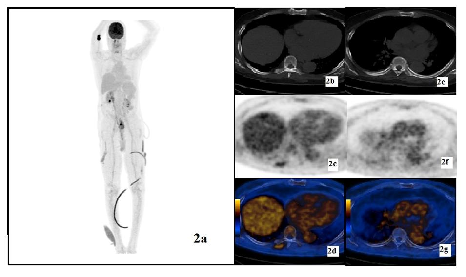 (a) Rotating 3D MIP image from the NaF18-PET/CT bone scan showing innumerable small osteoblastic bony metastases in the axial skeleton including all vertebral bodies, right acromion, bilateral ribs