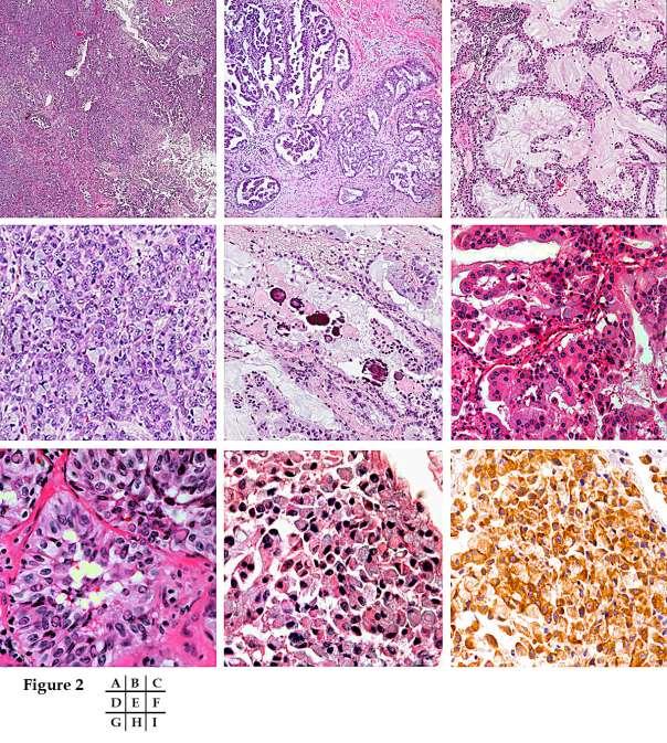 Fig. 2. Histologic features of anaplastic lymphoma kinase (ALK)-rearranged pulmonary adenocarcinoma. (A) ALK-rearranged tumors show variable growth patterns.