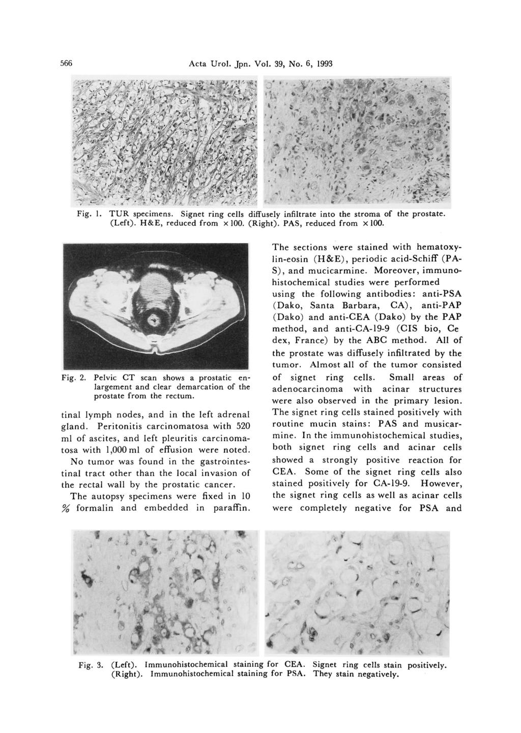 566 Acta Urol. Jpn. Vol. 39, No.6, 1993... It.. '. \., Fig. I. TUR specimens. Signet ring cells diffusely infiltrate into the stroma of the prostate. (Left). H&E, reduced from x 100. (Right).