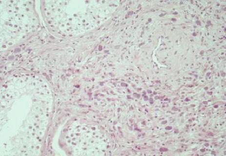 Case Reports in Oncological Medicine 3 (a) (b) (c) Figure 2: (a) The testicular parenchyma is infiltrated by neoplastic signet-ring cells (hematoxylin-eosin 200).