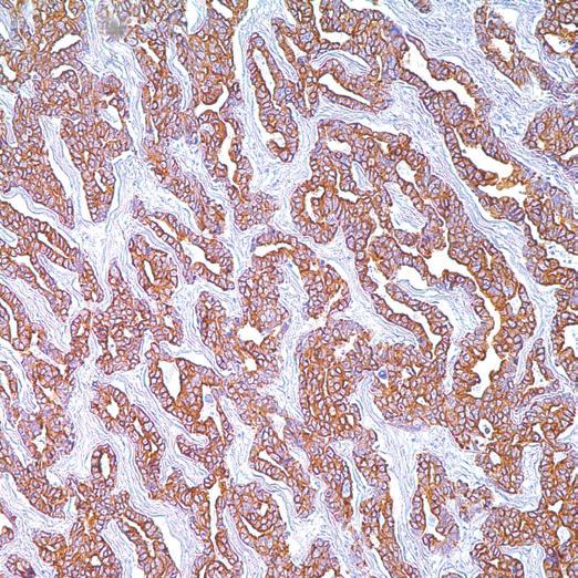 sometimes be variation in distribution of CD117 positivity within a given tumor, in most cases staining is diffuse.
