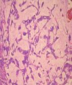 adenocarcinoma with lake of