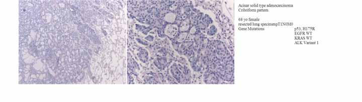 Fig. 4. Histological images of ALK lung cancer. In ALK-positive lung cancer, adenocarcinoma is said to commonly exhibit a characteristic cribriform pattern.